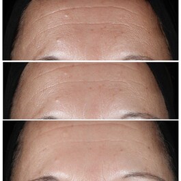 Smart Clinical Repair™ - Wrinkle Correcting Serum