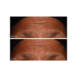DermInfusions - Gel zur schnellen Regeneration