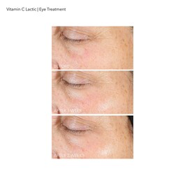 Vitamin C Lactic - Augenkonturenpflege für neuen Glow
