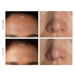 Kiwi™ - LED Technology Vacuum to Cleanse Pores and Remove Blackheads