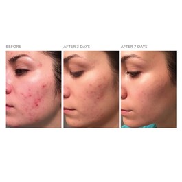 DRx Blemish Solutions Breakout Clearing Gel 