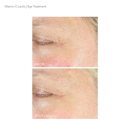 Vitamin C Lactic - Augenkonturenpflege für neuen Glow