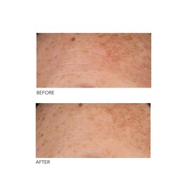 Alpha Beta® Peel Universal Formula