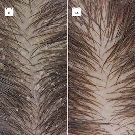 Serum Anti-Pelliculaire Anti-Recidive - Anti-Schuppen-Kopfhautserum