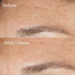 Resurgence - Revitalisierendes Multi-Säuren-Peeling
