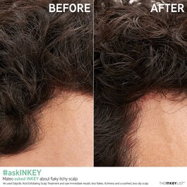 Salicylic Acid Scalp Treatment