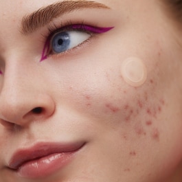 Patches zur Aknebehandlung - Mikroperforation