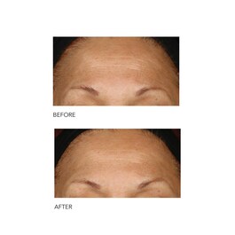 Alpha Beta® - Peel Extra Strength