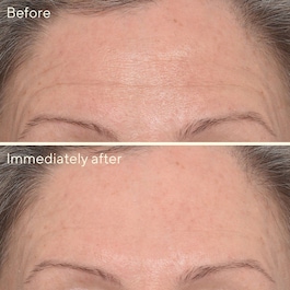 Resurgence, Targeted Wrinkle Corrector