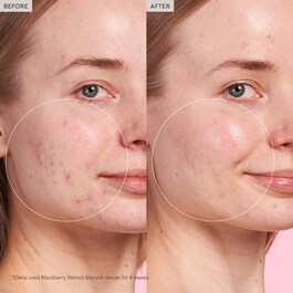 Blackberry Retinol - Blemish Serum