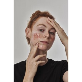 Anti-Rötungs-Lösung mit Azelainsäure 10 % - Gesichtsserum