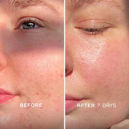 Evercalm™ - Elixier zur Stärkung der Hautbarriere