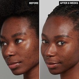 Tranexamsäure Nachtpflege gegen Hyperpigmentation