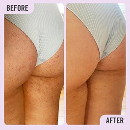 KP Bump Eraser Body Scrub with 10% AHA - Körper-Peeling mit AHAs