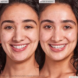 Blackberry Retinol - Blemish Serum