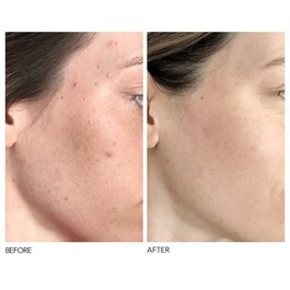 Alpha Beta® Peel Universal Formula
