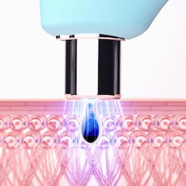 Kiwi™ - LED Technology Vacuum to Cleanse Pores and Remove Blackheads