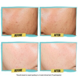 Blemish Treating & Preventing Lotion - Reinigungsschaum