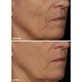 FaceWare Pro - LED-Gesichtsmaske
