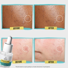 Blemish-Clearing Solution - Hautunreinheiten