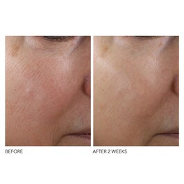 Advanced R + F Overnight Texture Renewal - Peeling
