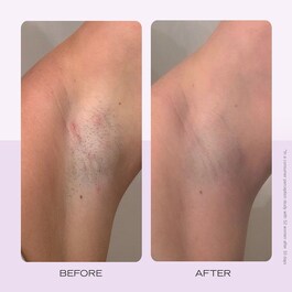 Ingrown Hair Pads - Kompostierbare Pads gegen eingewachsene Haare x60