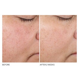 Advanced R + F Overnight Texture Renewal - Peeling