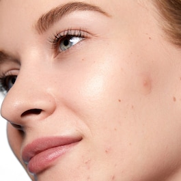 Acne Day Dot - Anti-Pickel-Patches
