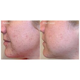 Blemish Control - Tägliches klärendes Peeling 