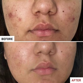 CENTELLA ACNE CARE - BERUHIGENDES FLUIDE